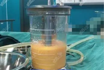 燕郊360度水动力吸脂费用多少钱？