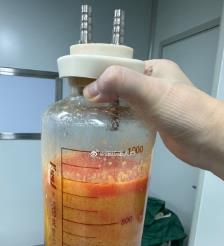 燕郊水动力吸脂手术要做多久？